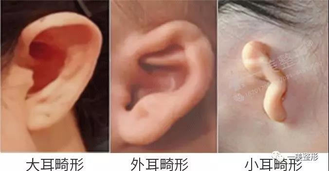 小孩子耳畸形怎么治疗