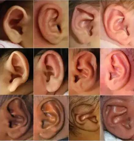 先天性小耳畸形分类