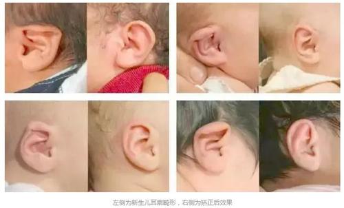 宝宝耳畸形治疗效果